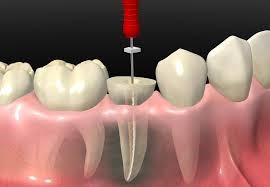 Endodoncia