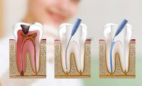 Endodoncia